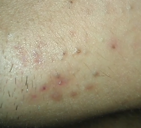 Left Side Chin Acne