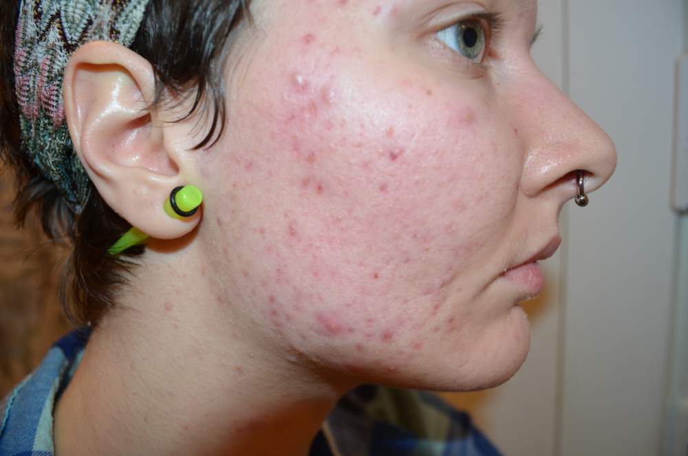 Acne Journey 2013