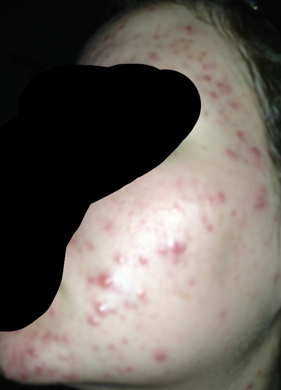 Folliculitis or acne?