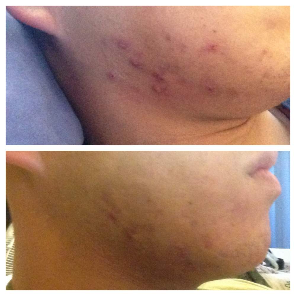 Jawline Acne - Jawline Acne - Pictures & Videos - Acne.org Community