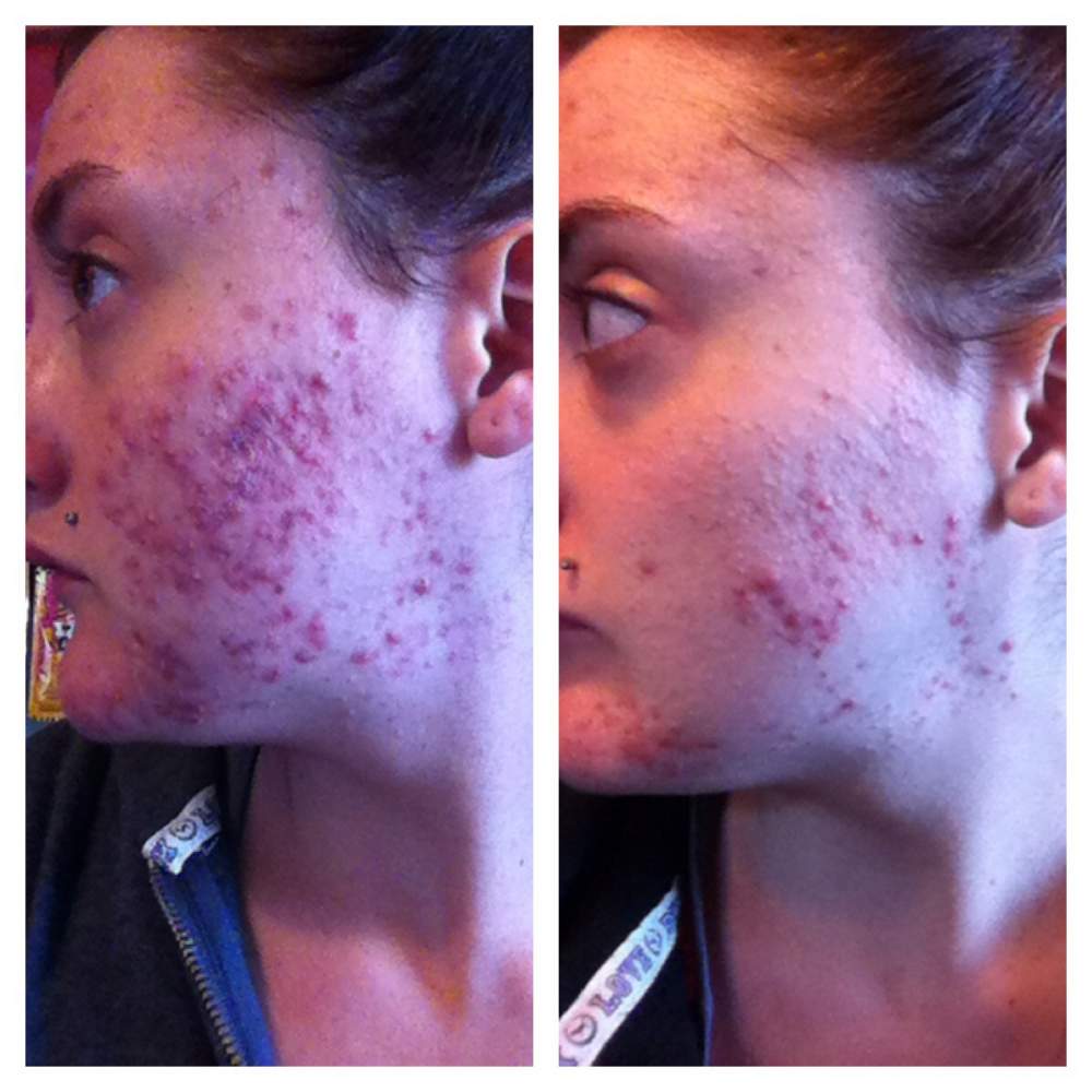 Prescription logs - Doxycycline Progress - cystic acne progression