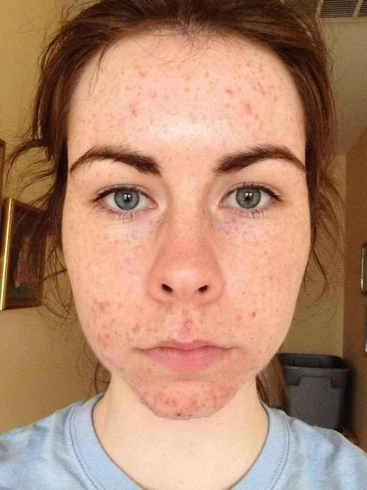 WEEK TWO - Proactiv - Full Face