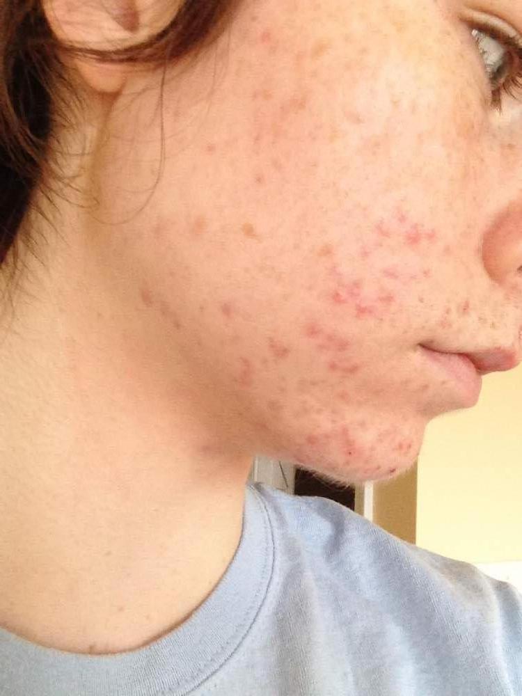 WEEK TWO - Proactiv - Right Side