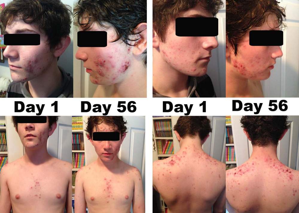 accutane before and after body