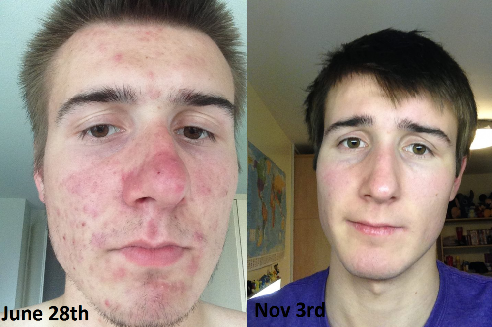 Accutane Isotretinoin Logs Roaccutane Journey Accutane Image 1