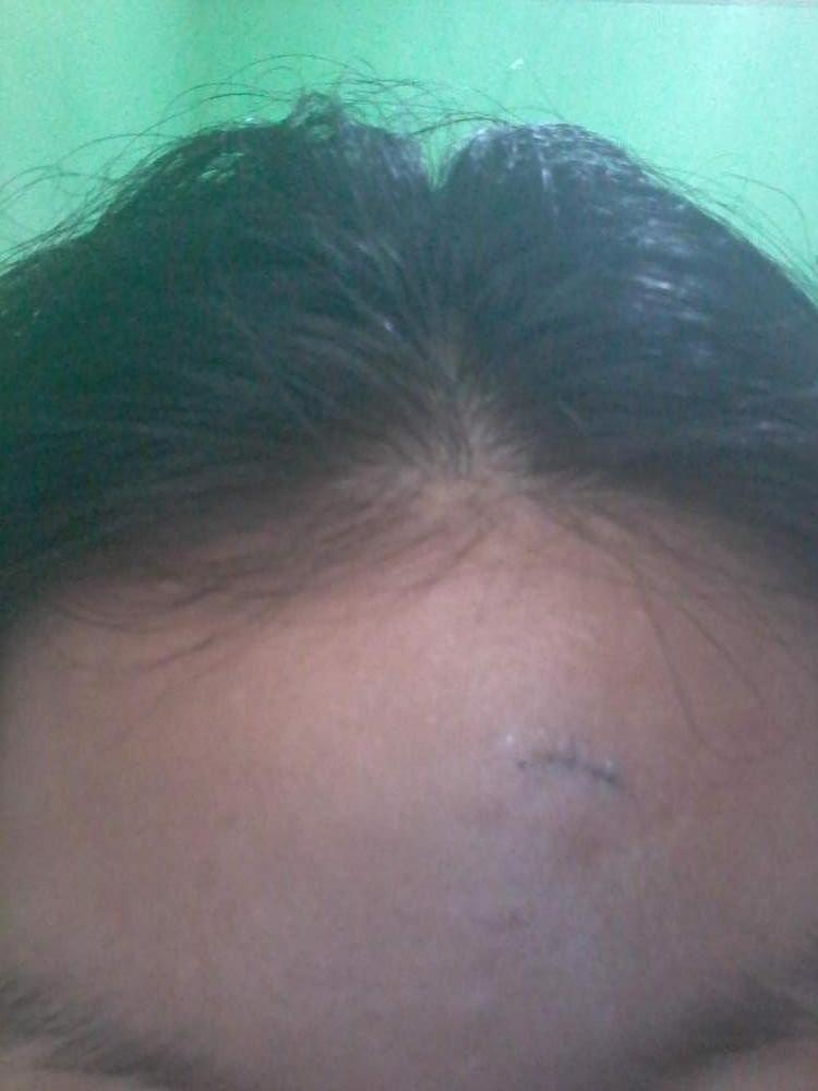 forehead excision
