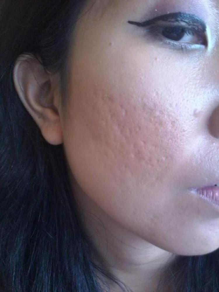 acne scar right cheek