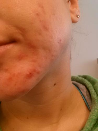 Accutane Journey (Absorica / Claravis)
