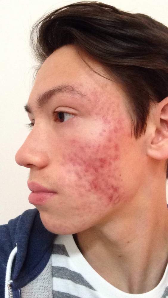16 (almost 17 weeks) on accutane