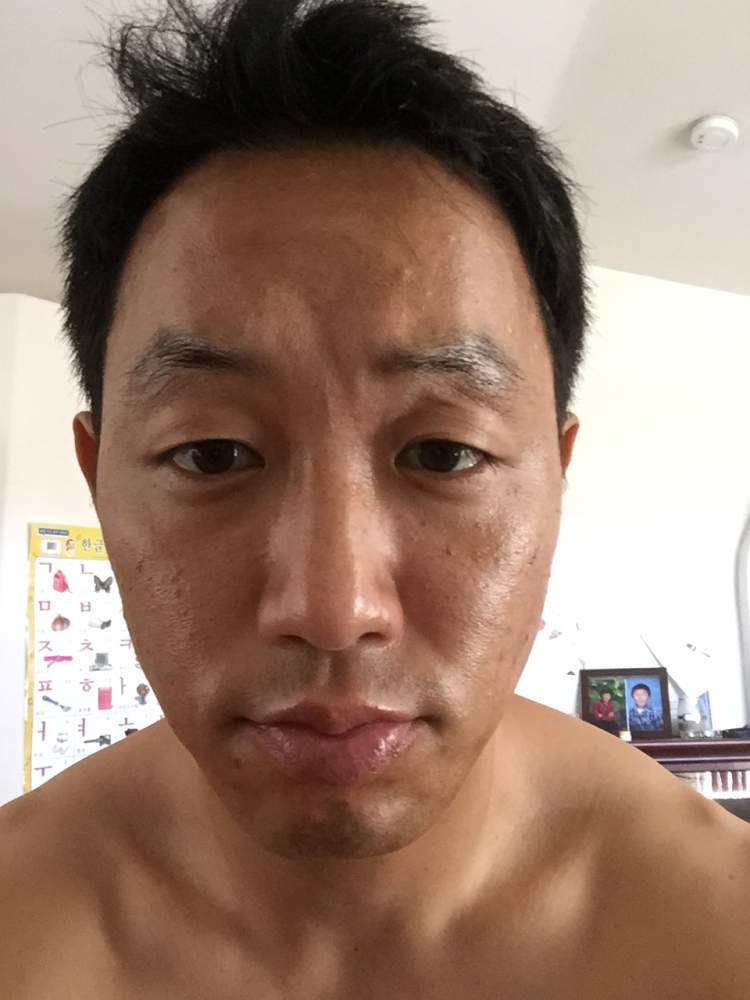 Day 2 Acne.org 3/8/2015