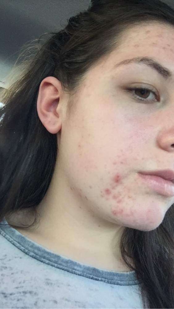 Left side of chin - Hormonal acne!!! - Pictures &amp; Videos 