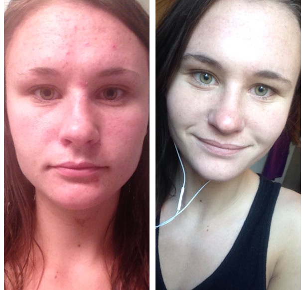 diane 35 acne treatment