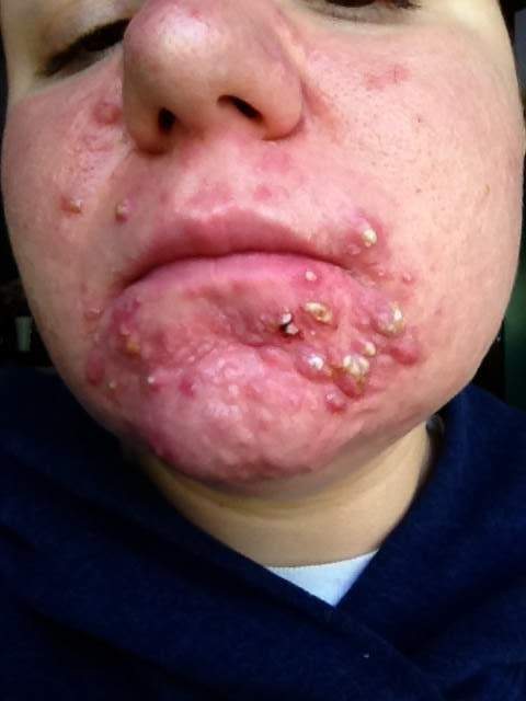 acne dating site girlfriend cum face