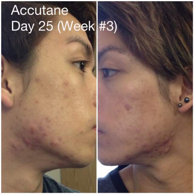 accutane when you see results