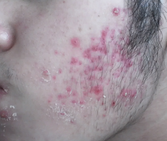 Isotretinoin For Acne Marks