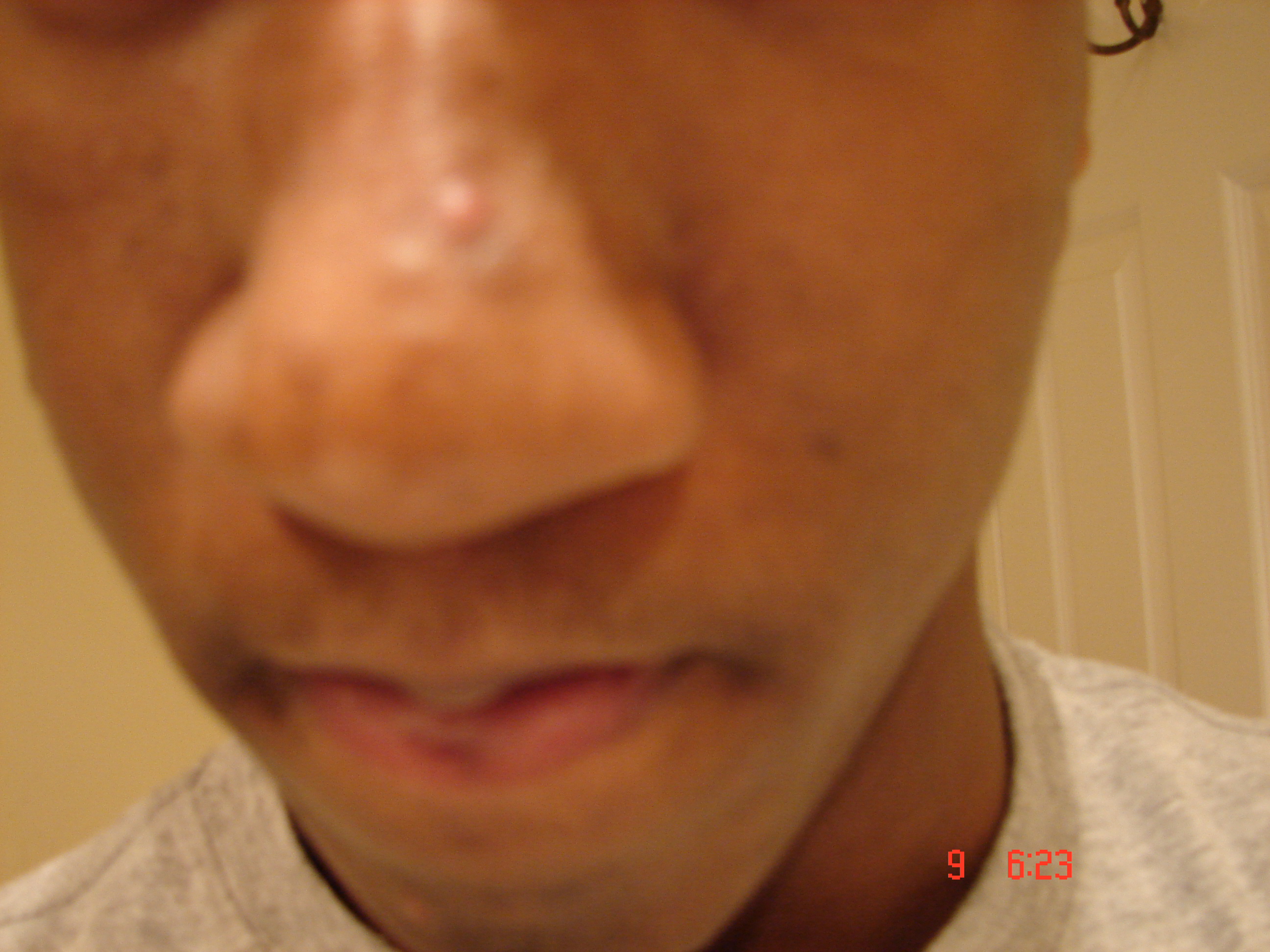 how-to-get-rid-of-these-bumps-on-my-nose-general-acne-discussion