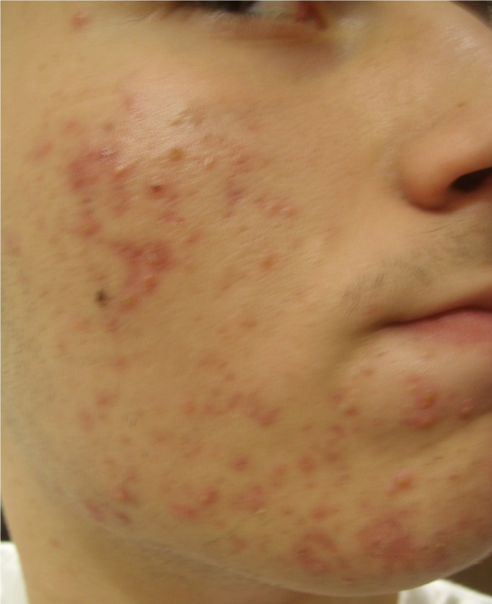 Tazorac .05 cream Log (pics) - Personal logs - Acne.org