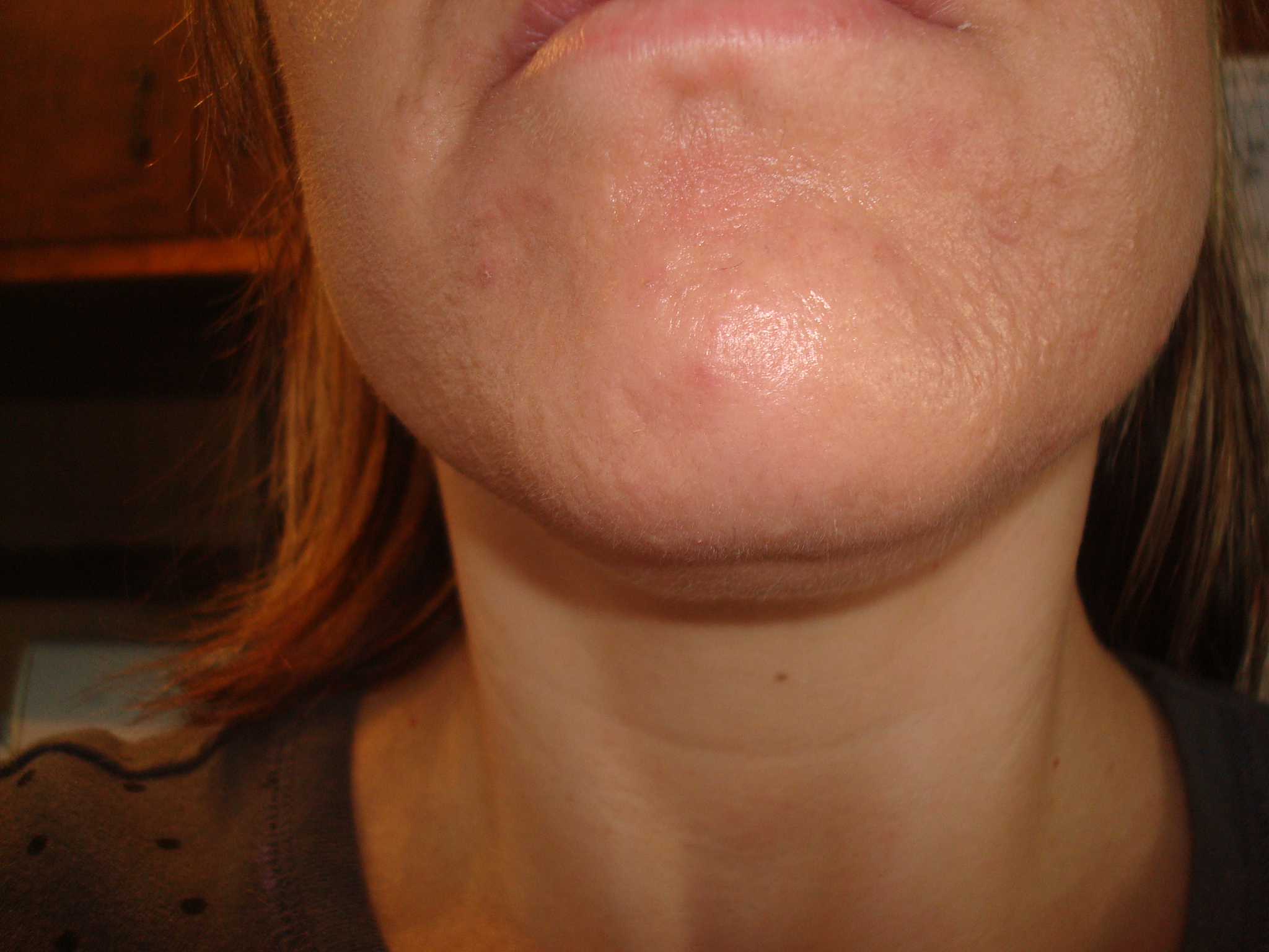 how-do-i-get-rid-of-these-bumps-on-my-chin-adult-acne-acne