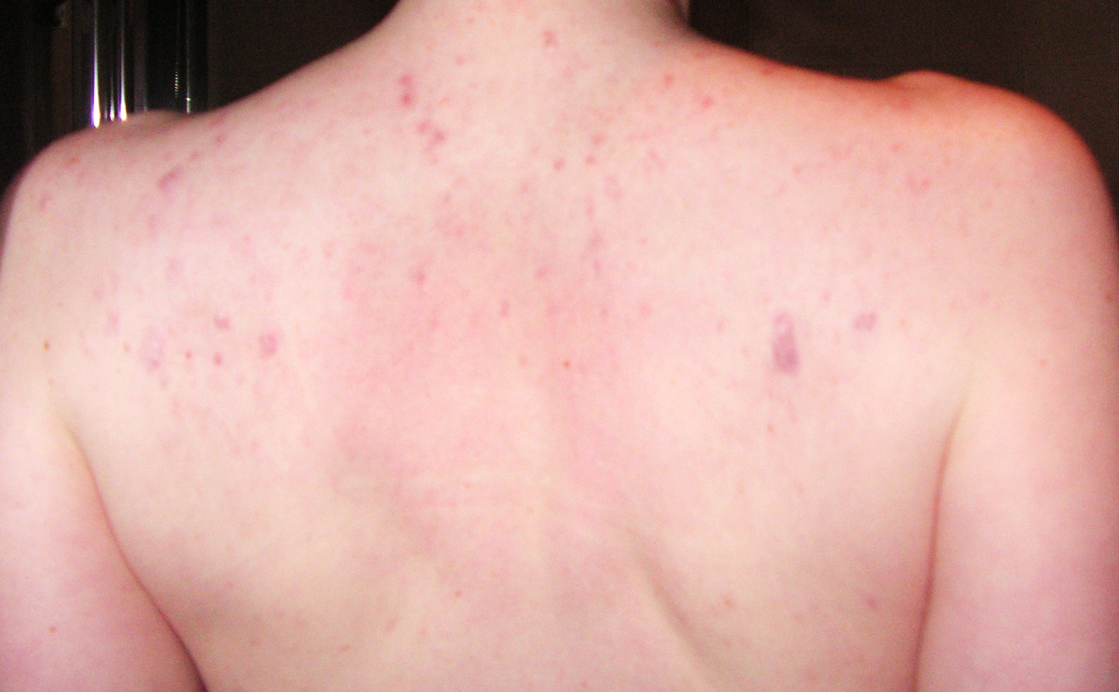 Moderate/severe back acne regimen log - The Acne.org Regimen logs