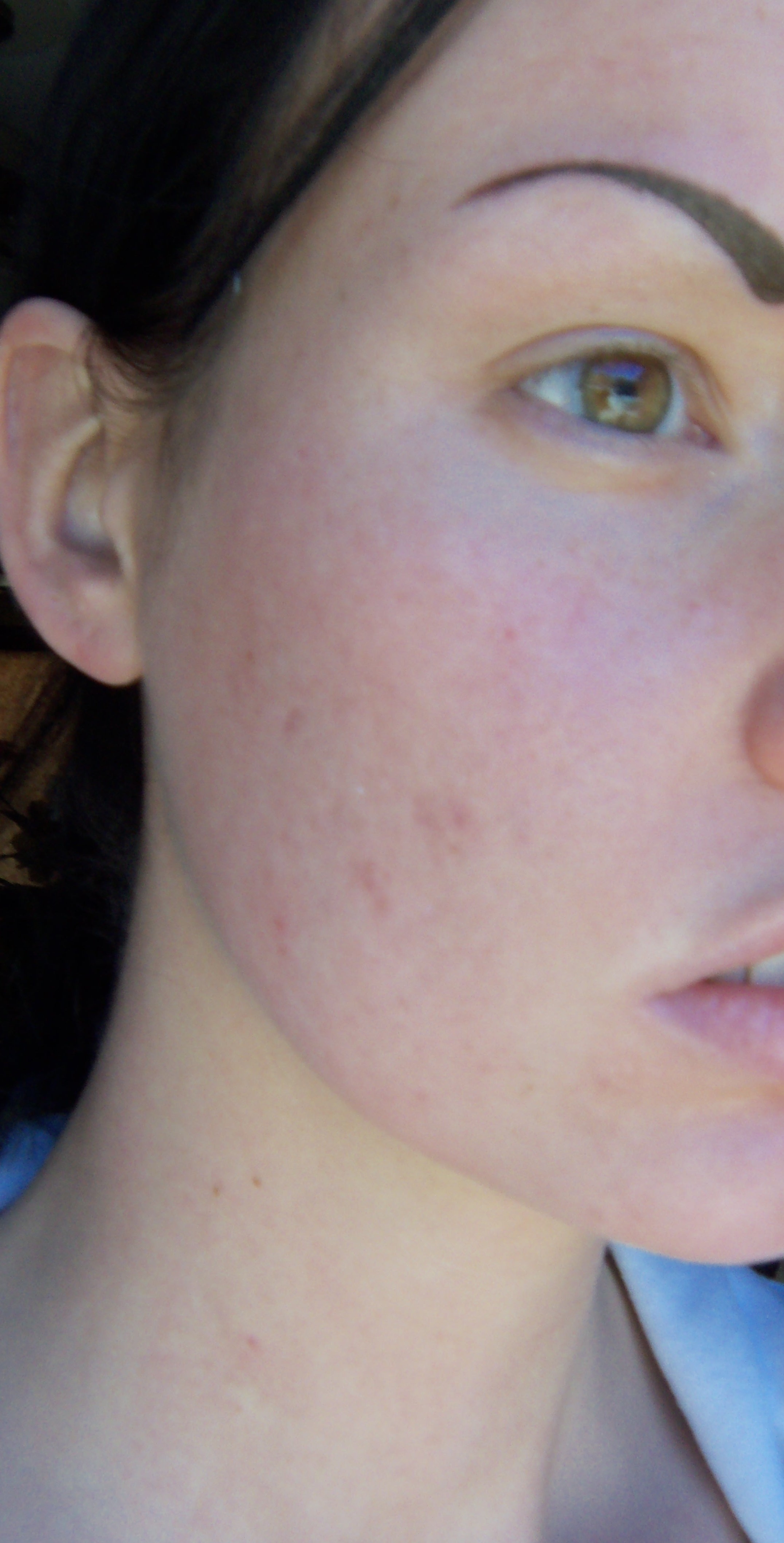 Spiro VS. Hormonal Acne Personal logs