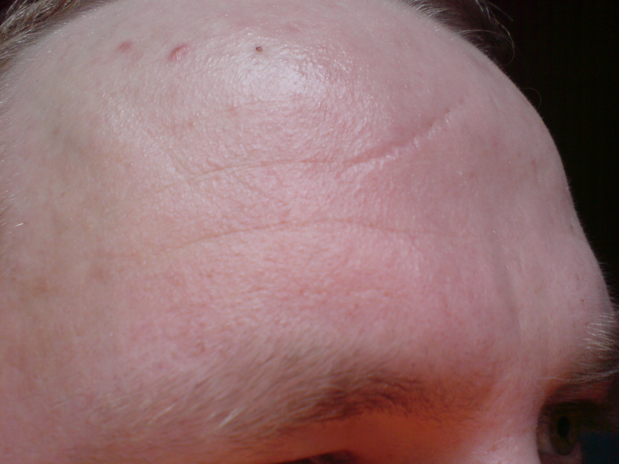 forehead-rash-causes