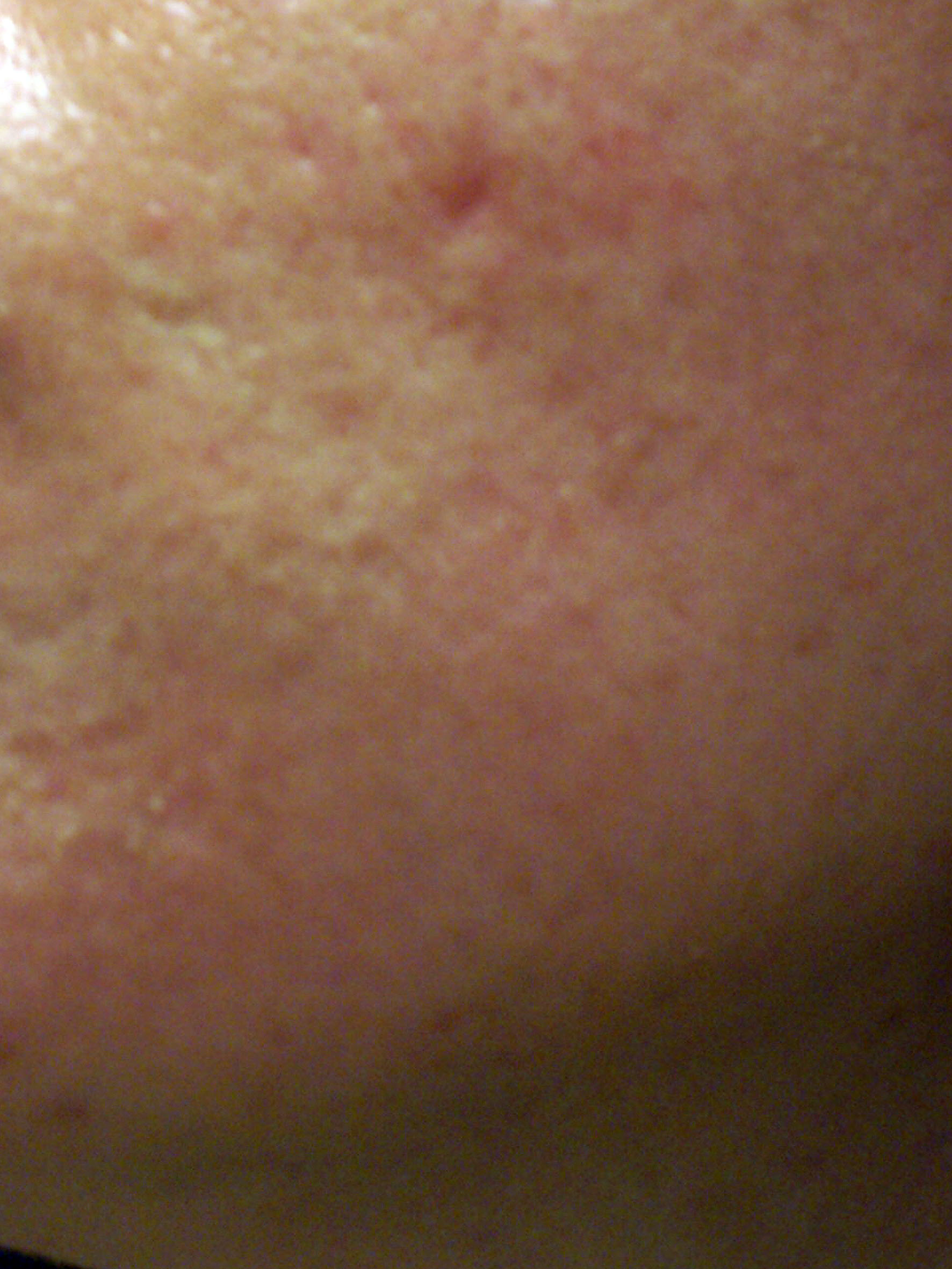 a hole in my cheek Scar treatments