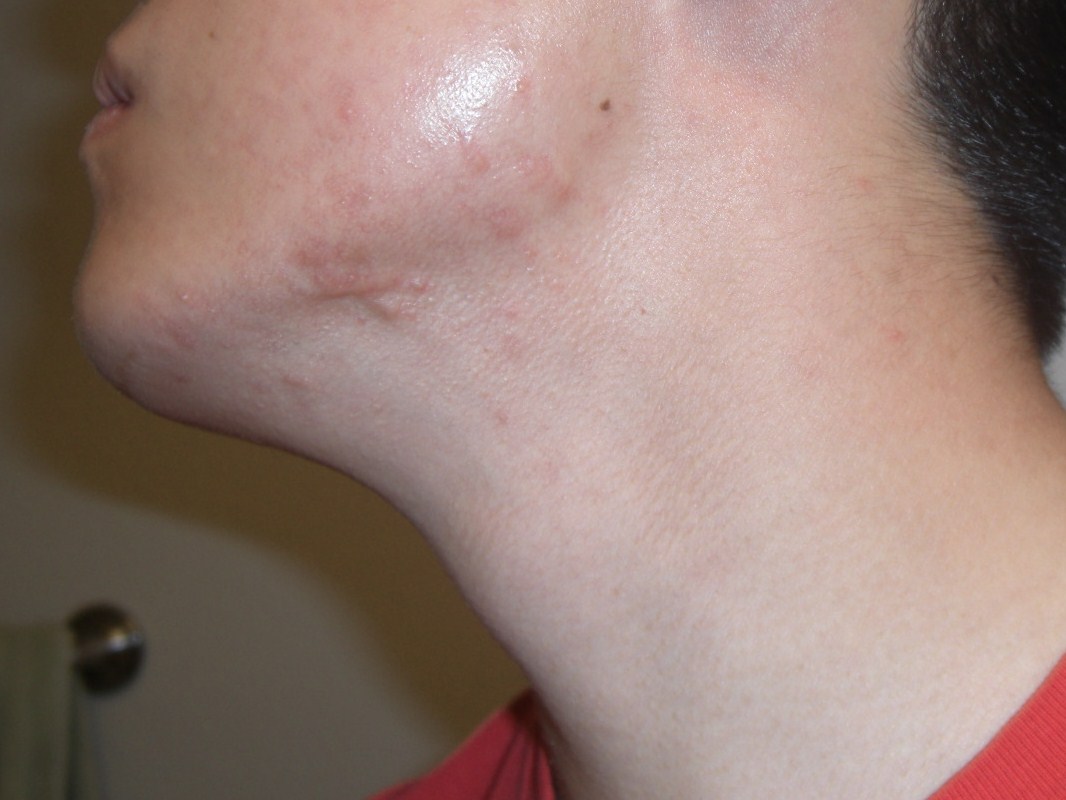 Small Whiteheads Reoccuring Problems General Acne Discussion