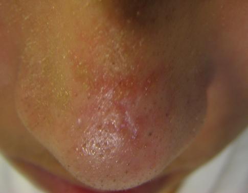 help red mark on nose hyperpigmentation red dark marks apple cider vinegar for hyperpigmentation
