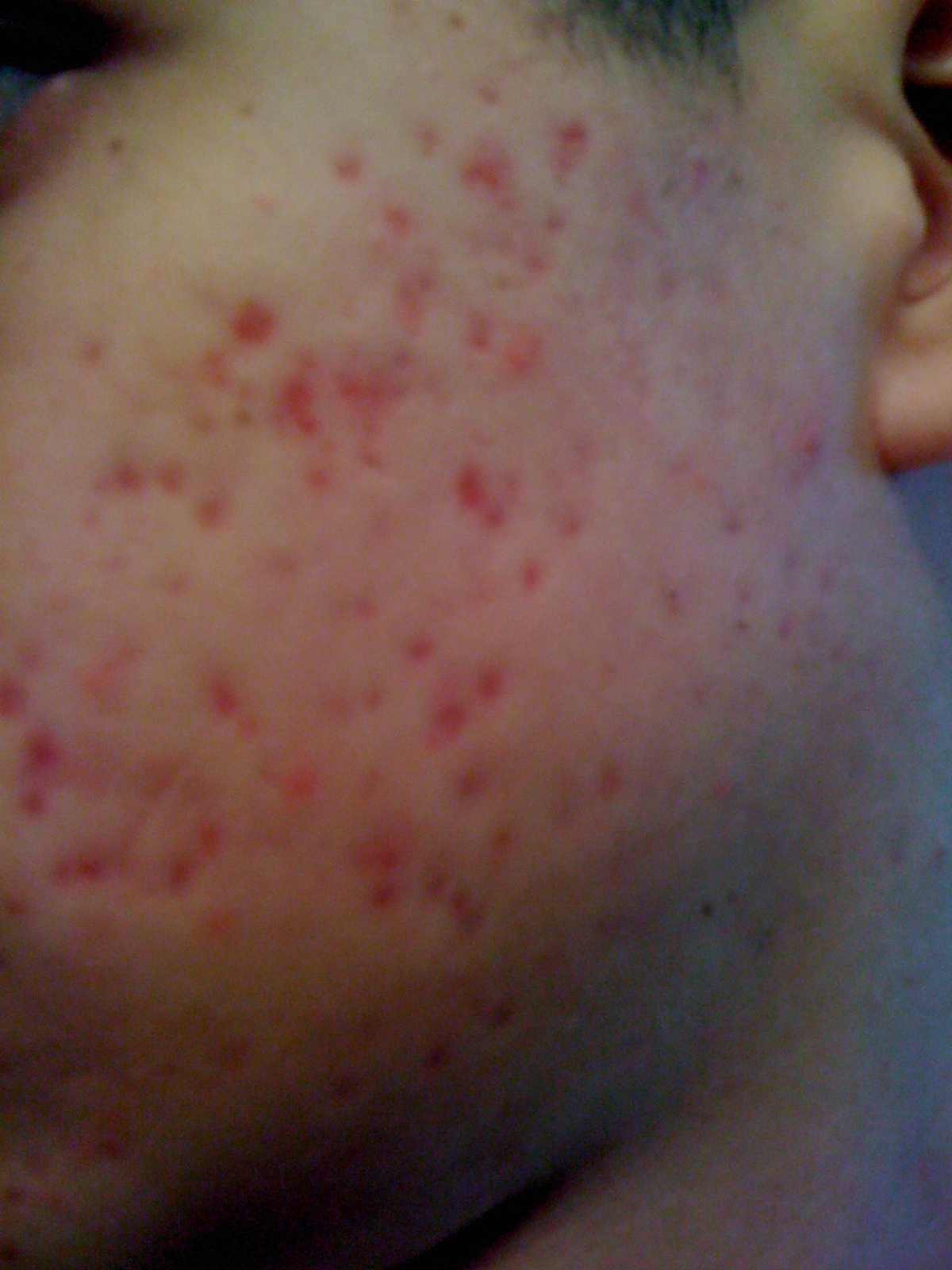 Worst Breakout ever = worst post acne marks...HELP - Scar treatments