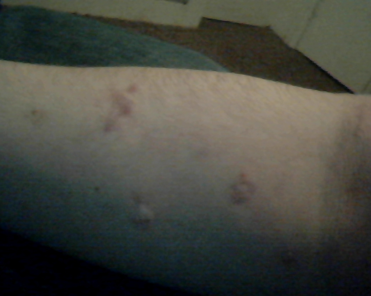 Body with scars/hypertrophic scars Hypertrophic (raised) scars