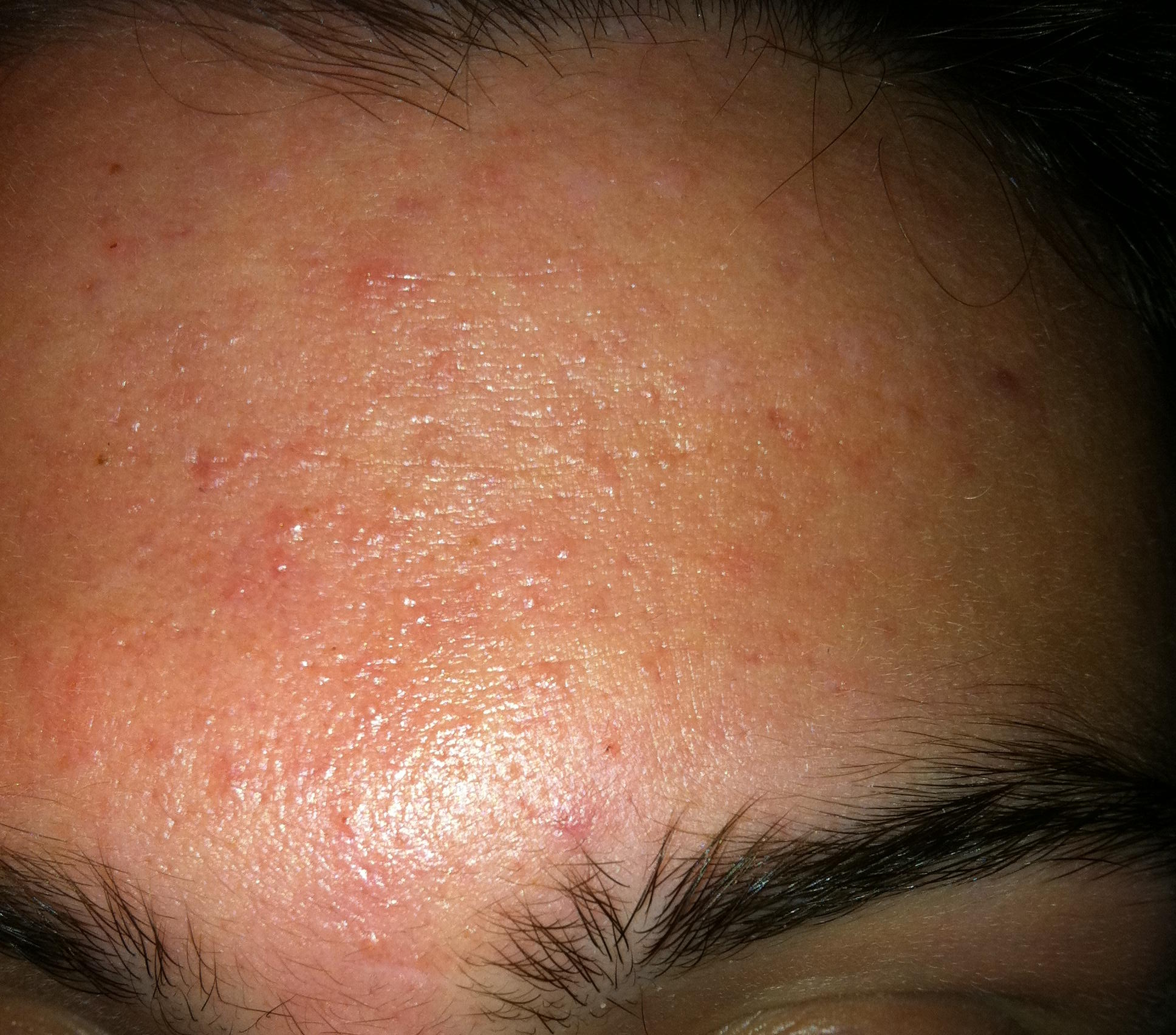 HELP! Folliculitis/pityrosporum folliculitis? - General acne discussion ...