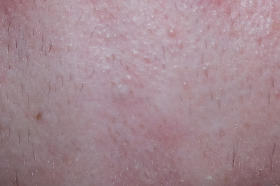 Huge White Scabby Bumpsores On Lips Pics Included General Acne