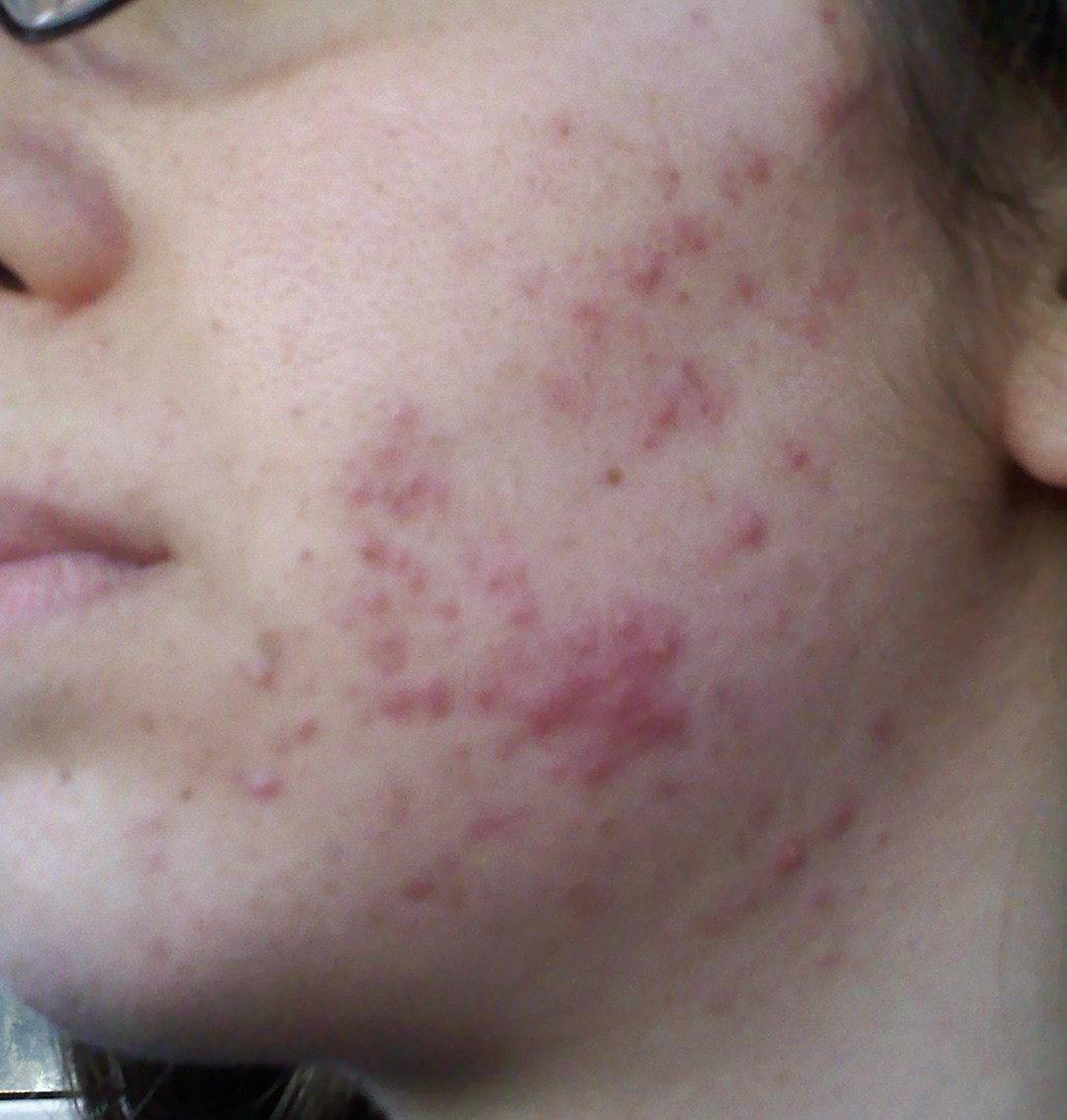 sudden-acne-adult-acne-acne