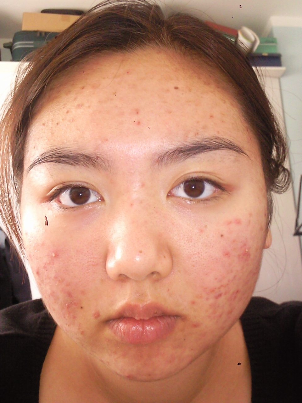 Accutane - NHS Log (with pics) - Accutane (isotretinoin) logs - by