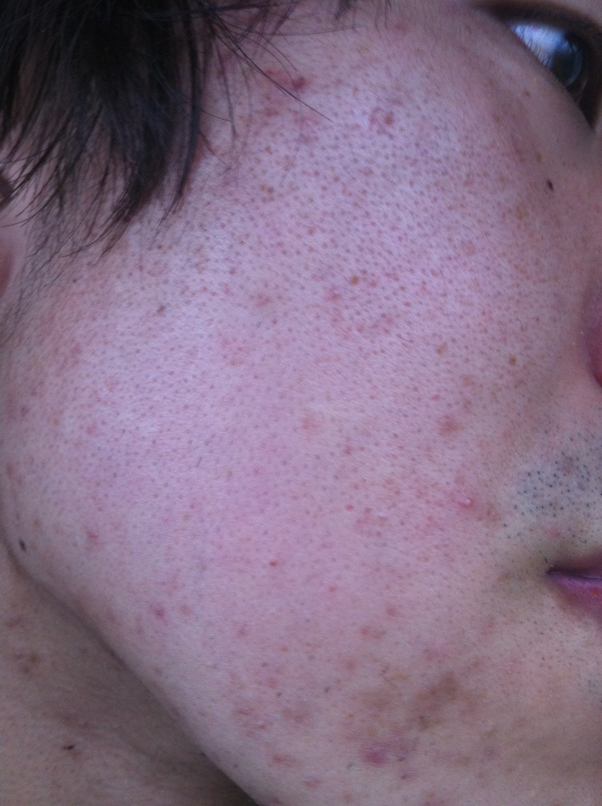 weird-marks-on-face-pics-scar-treatments-acne