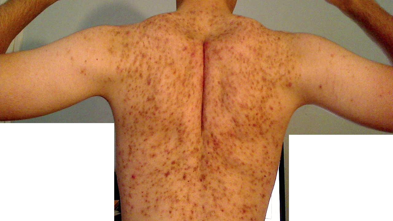 How do I get rid of my severe bacne/scars. I had this for ...
