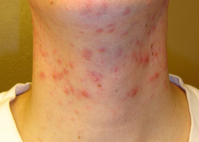 severe-acne-on-the-face-and-chest-clinical-advisor