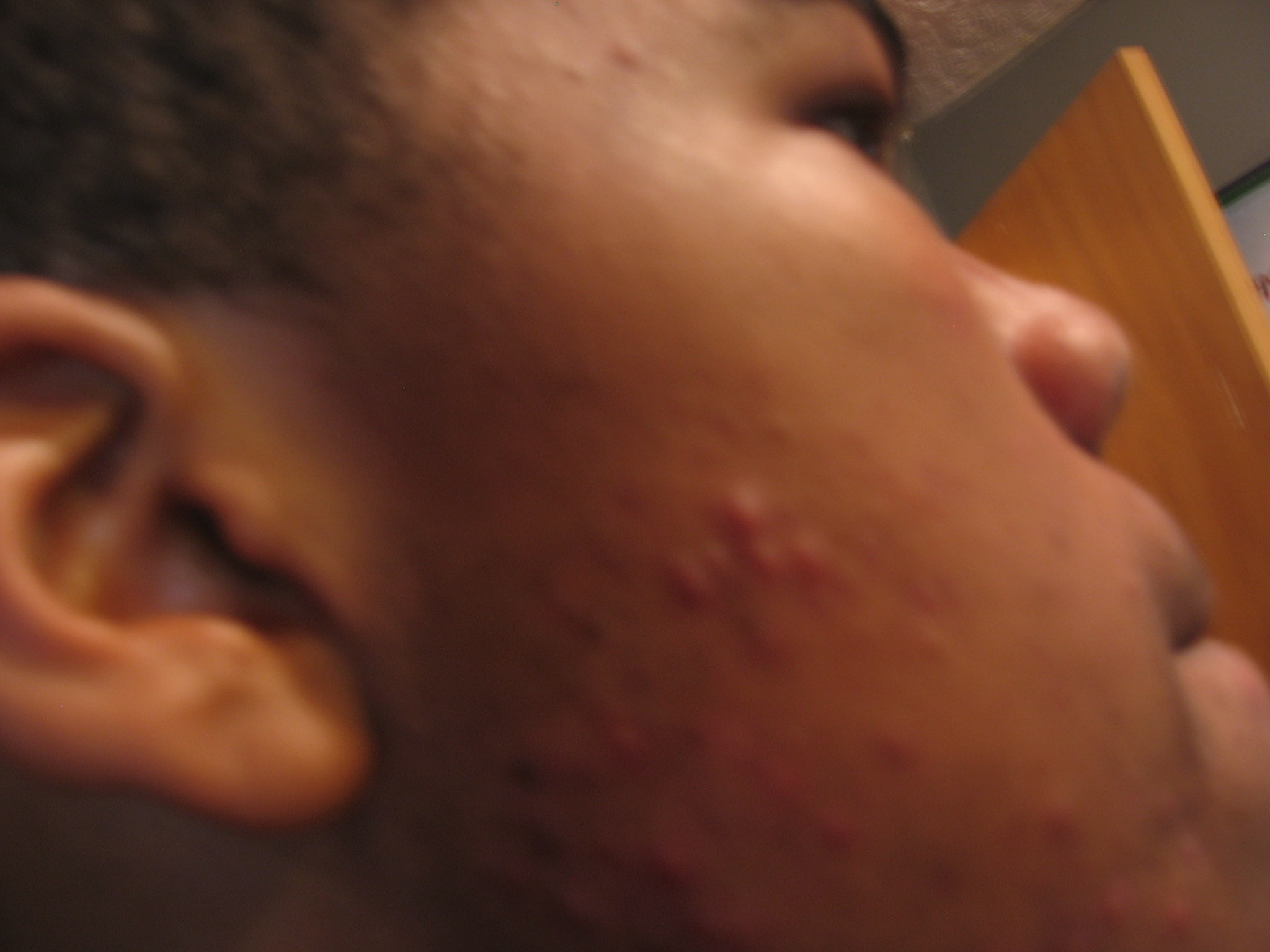 Painful Pauples Small White Bumps General Acne Discussion