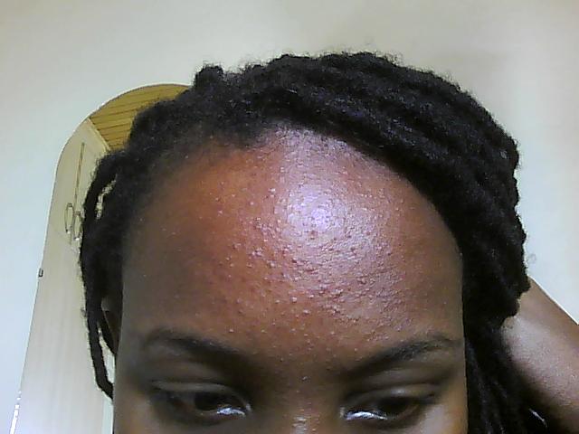 very itchy acne-like rash on forehead: HELP - General acne discussion ...