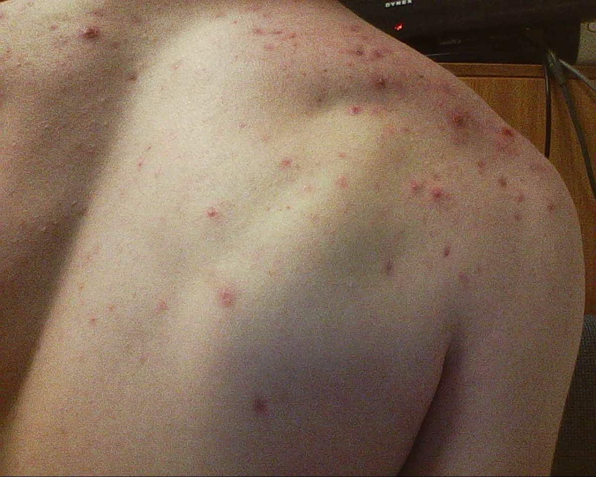 Need Help/advice (Pictures) - Back/Body/Neck acne - Acne.org Community