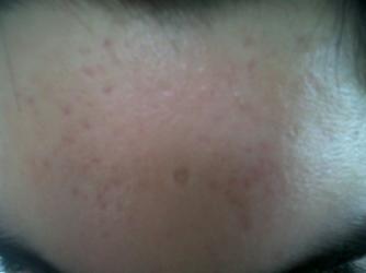 Hw Long Does Differin Or Tretinoin Take To Get Rid Of Old Hw Long Does Differin Or Tretinoin Take To Get Rid Of Old