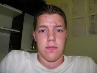 Epiduo With Pics - Personal logs - Acne.org Community Epiduo With Pics - Personal logs - Acne.org Community