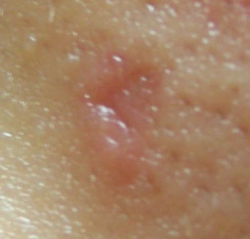 mole scar removal face rid left acne btw