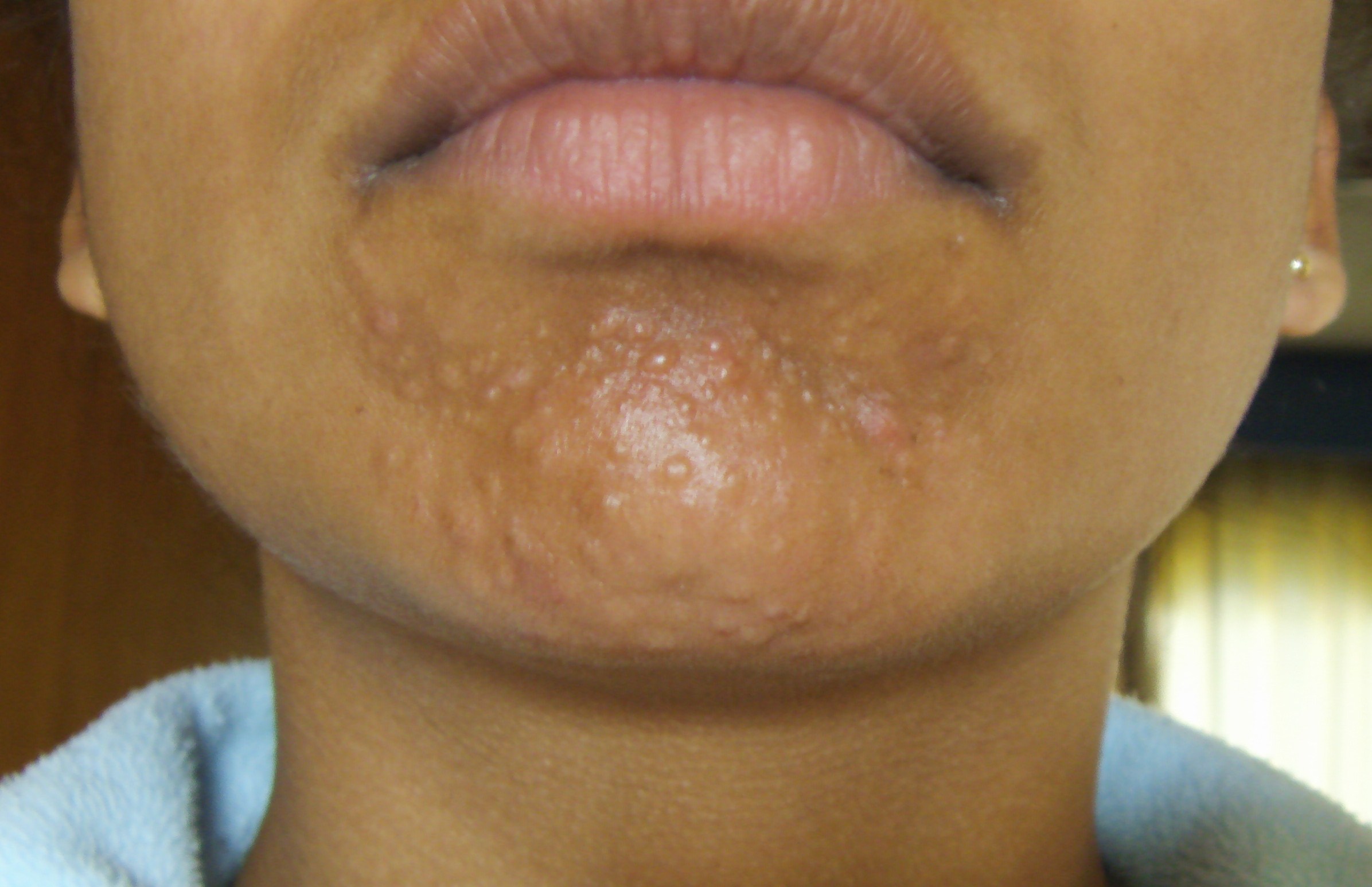 small-bumps-on-chin-scars-milia-fungal-infection-general-acne