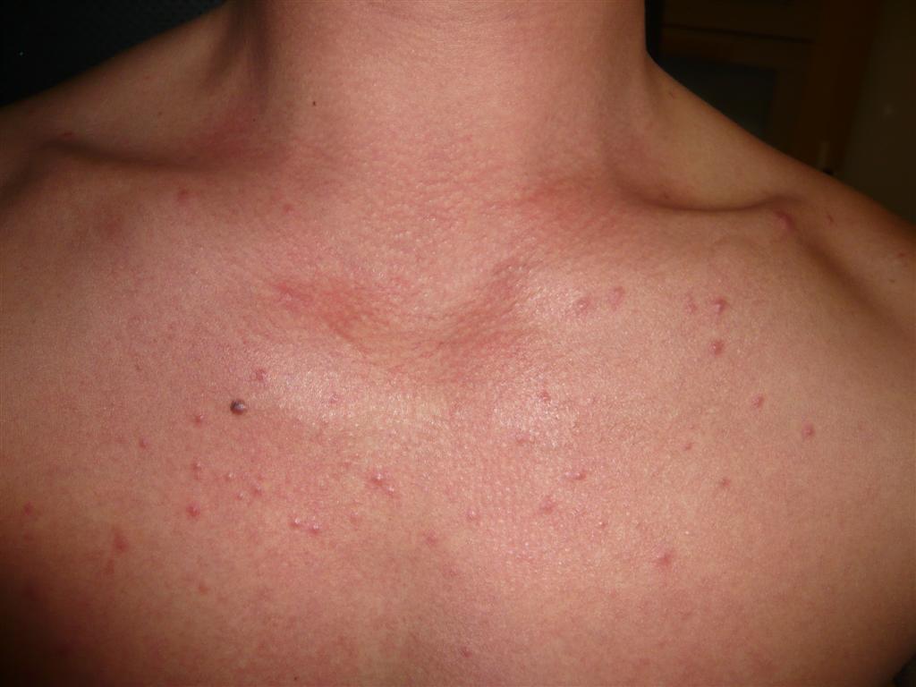 Treating Pityrosporum Folliculitis with Itraconazole - Back/Body/Neck ...