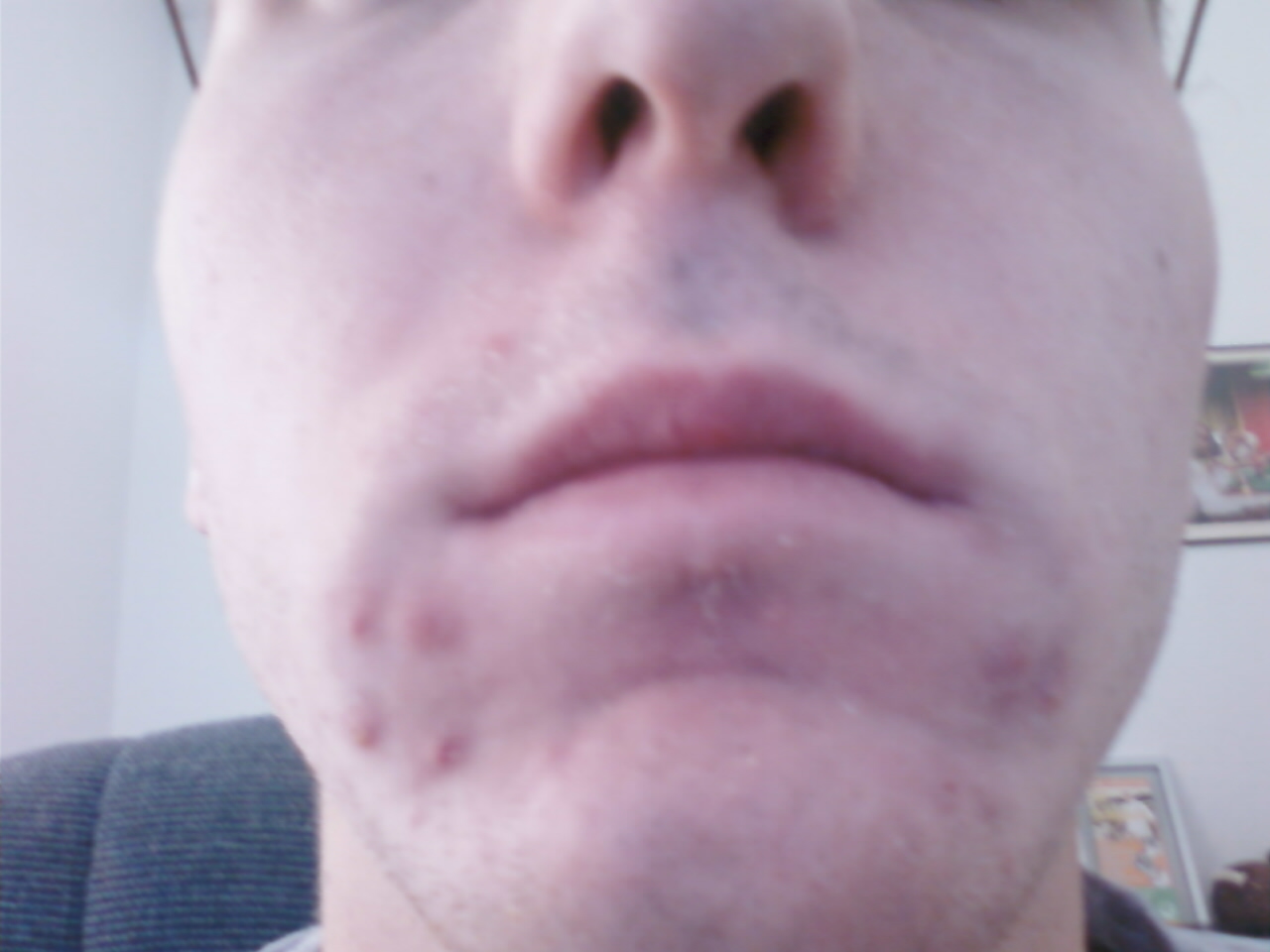 always-get-acne-under-corners-of-mouth-general-acne-discussion-acne