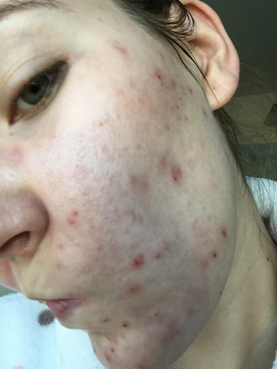 Before Accutane 2.jpg