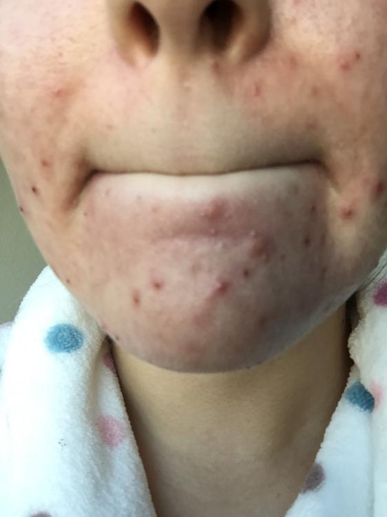 pores accutane for and comedones clogged
