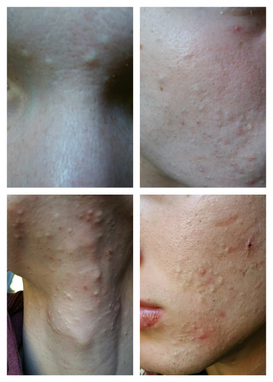 acne.jpg.png