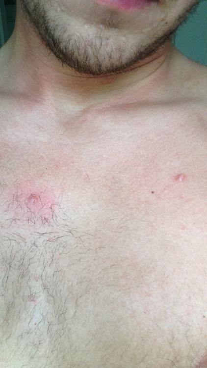 Acne Bumps On Chest That Wont Pop General Acne Discussion